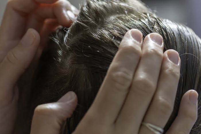 Saç Biti Nasıl olur? Nasıl Temizlenir?