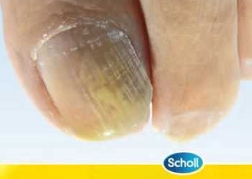 Dr Scholl Fungal Nail Tırnak Mantar Tedavisi